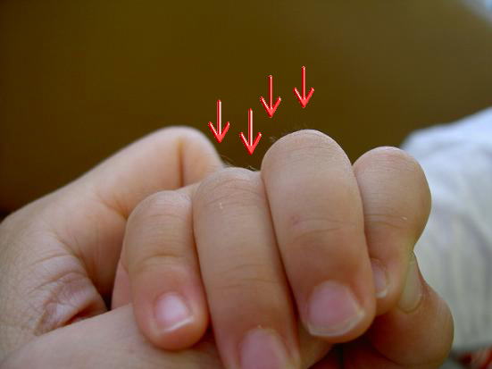 赤い矢印を見て下さい。中指、薬指の背中にニョキニョキと生えているのがそうです。矢印以外に人差し指の背中にも少し写っています。