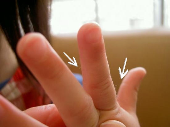 白い矢印を見て下さい。人差し指にニョキニョキと生えているのがそうです。矢印以外も写っています。